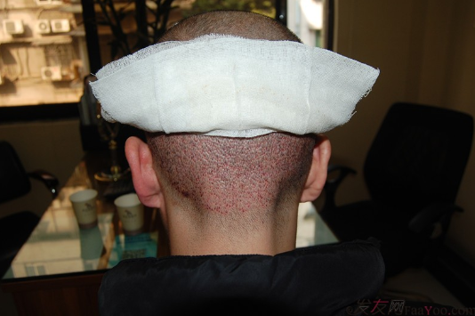 5級脫發(fā)大麥微針植發(fā)經(jīng)歷，三年時間兩次手術(shù)6800單位追求完美效果