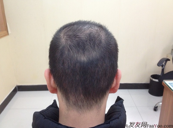 5級脫發(fā)大麥微針植發(fā)經(jīng)歷，三年時間兩次手術(shù)6800單位追求完美效果