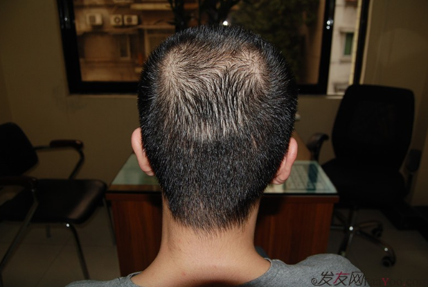 5級脫發(fā)大麥微針植發(fā)經(jīng)歷，三年時間兩次手術(shù)6800單位追求完美效果