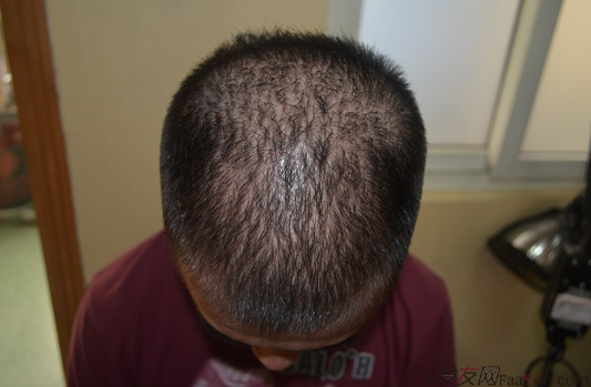 5級脫發(fā)大麥微針植發(fā)經(jīng)歷，三年時間兩次手術(shù)6800單位追求完美效果