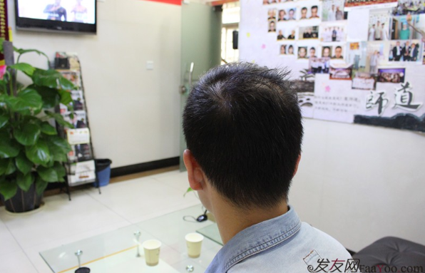 5級脫發(fā)大麥微針植發(fā)經(jīng)歷，三年時間兩次手術(shù)6800單位追求完美效果