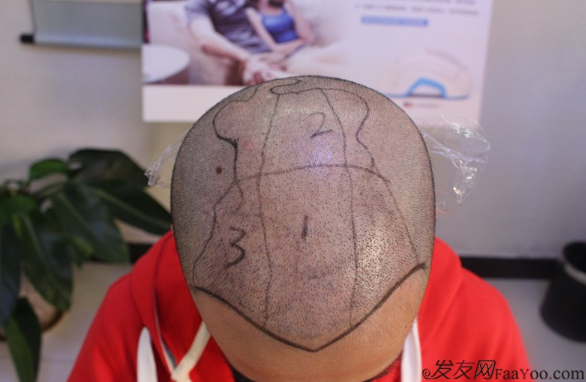 5級脫發(fā)大麥微針植發(fā)經(jīng)歷，三年時間兩次手術(shù)6800單位追求完美效果
