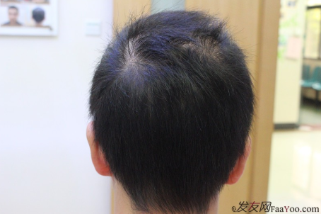 5級脫發(fā)大麥微針植發(fā)經(jīng)歷，三年時間兩次手術(shù)6800單位追求完美效果