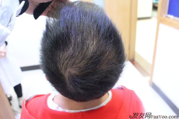 5級脫發(fā)大麥微針植發(fā)經(jīng)歷，三年時間兩次手術(shù)6800單位追求完美效果
