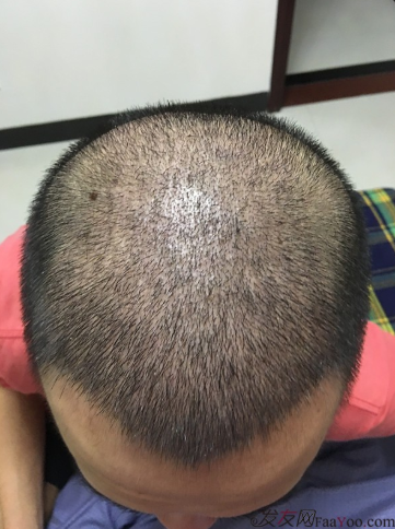 5級脫發(fā)大麥微針植發(fā)經(jīng)歷，三年時間兩次手術(shù)6800單位追求完美效果