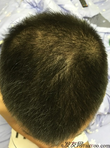 5級脫發(fā)大麥微針植發(fā)經(jīng)歷，三年時間兩次手術(shù)6800單位追求完美效果