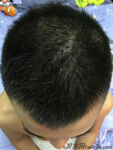 5級脫發(fā)大麥微針植發(fā)經(jīng)歷，三年時間兩次手術(shù)6800單位追求完美效果