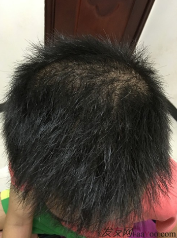 5級脫發(fā)大麥微針植發(fā)經(jīng)歷，三年時間兩次手術(shù)6800單位追求完美效果