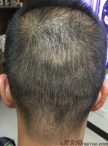 5級脫發(fā)大麥微針植發(fā)經(jīng)歷，三年時間兩次手術(shù)6800單位追求完美效果
