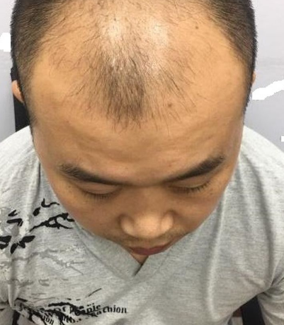 重慶頭頂大面積植發(fā)，看五個(gè)月后的效果我滿(mǎn)意了