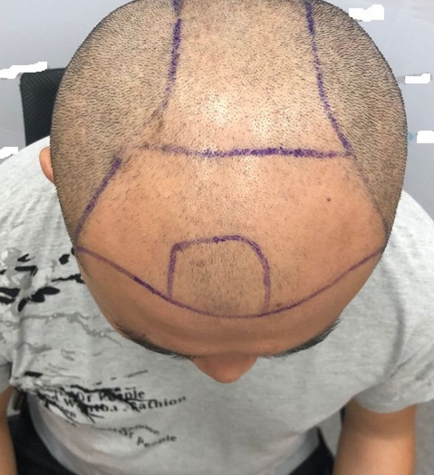 重慶頭頂大面積植發(fā)，看五個(gè)月后的效果我滿(mǎn)意了