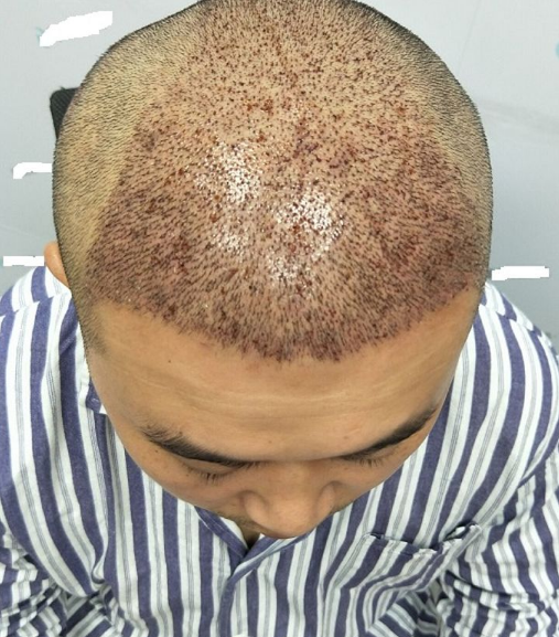 重慶頭頂大面積植發(fā)，看五個(gè)月后的效果我滿(mǎn)意了