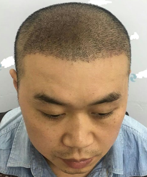 重慶頭頂大面積植發(fā)，看五個(gè)月后的效果我滿(mǎn)意了