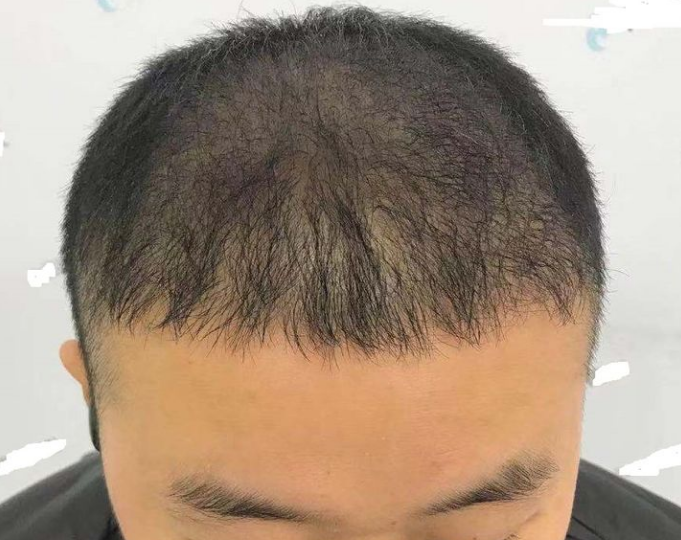 重慶頭頂大面積植發(fā)，看五個(gè)月后的效果我滿(mǎn)意了