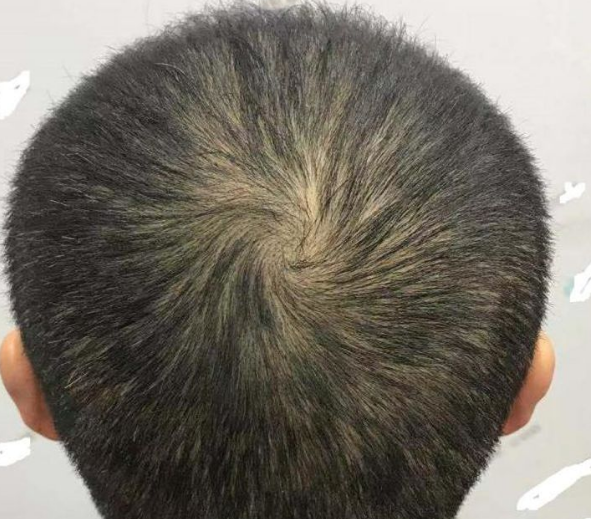 重慶頭頂大面積植發(fā)，看五個(gè)月后的效果我滿(mǎn)意了