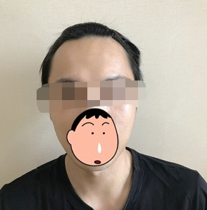 重慶發(fā)際線植發(fā)，改善大額頭的秘訣，來看看改變