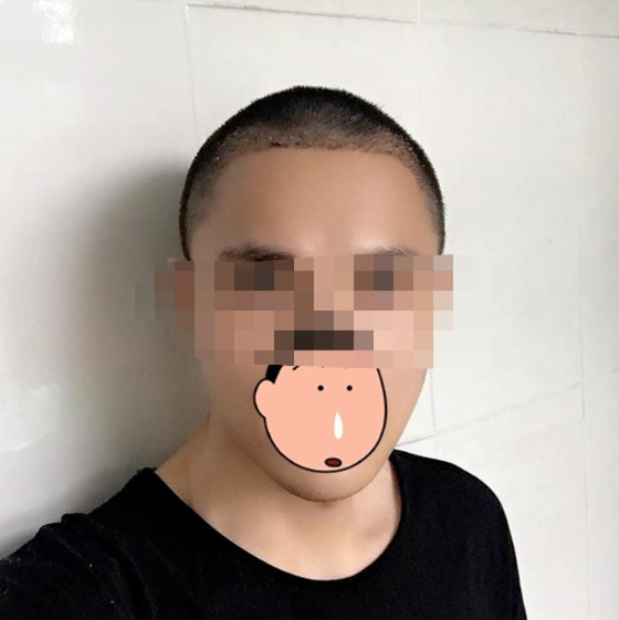 重慶發(fā)際線植發(fā)，改善大額頭的秘訣，來看看改變