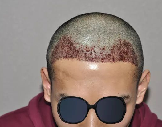 福建福州90后小伙記錄植發(fā)全過程，看看大額頭從大到小