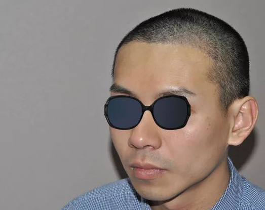 福建福州90后小伙記錄植發(fā)全過程，看看大額頭從大到小