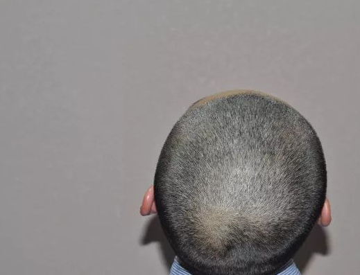 福建福州90后小伙記錄植發(fā)全過程，看看大額頭從大到小