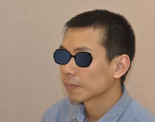 福建福州90后小伙記錄植發(fā)全過程，看看大額頭從大到小