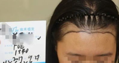 植發(fā)去哪里呢，山西雍禾植發(fā)2000單位，這變化實在太大了