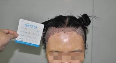 植發(fā)去哪里呢，山西雍禾植發(fā)2000單位，這變化實在太大了