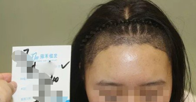 植發(fā)去哪里呢，山西雍禾植發(fā)2000單位，這變化實在太大了