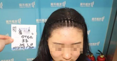 植發(fā)去哪里呢，山西雍禾植發(fā)2000單位，這變化實在太大了