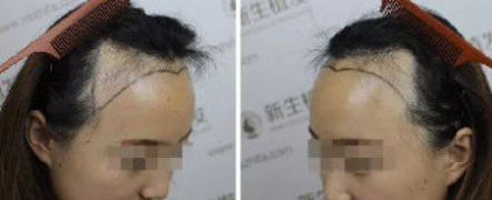 安徽發(fā)際線種植哪家好，進(jìn)來參考我在合肥新生種植3000單位效果