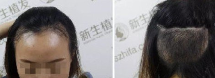 安徽發(fā)際線種植哪家好，進(jìn)來參考我在合肥新生種植3000單位效果