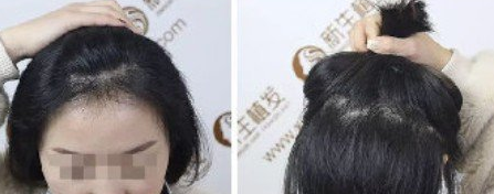 安徽發(fā)際線種植哪家好，進(jìn)來參考我在合肥新生種植3000單位效果