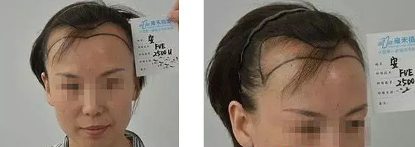 發(fā)際線正中后移兩指多寬，兩邊的額角更是翻倍地寬，腦門(mén)大，化妝很辛苦。