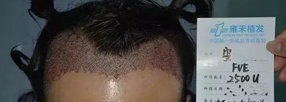 發(fā)際線正中后移兩指多寬，兩邊的額角更是翻倍地寬，腦門(mén)大，化妝很辛苦。