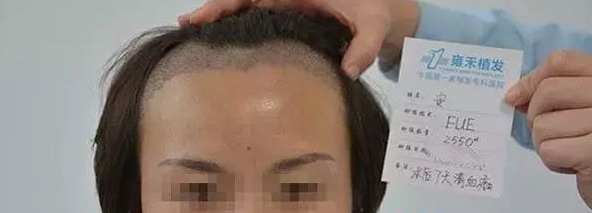 烏魯木齊雍禾植發(fā)案例，進(jìn)來(lái)看看我植發(fā)手術(shù)過(guò)程的點(diǎn)點(diǎn)滴滴