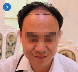 烏魯木齊植發(fā)案例，無痕種植毛囊術(shù)后效果