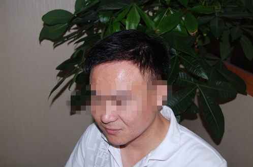 烏魯木齊植發(fā)案例，無痕種植毛囊術(shù)后效果