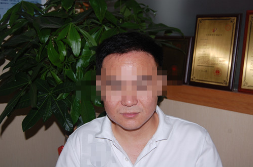 烏魯木齊植發(fā)案例，無痕種植毛囊術(shù)后效果