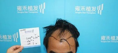 烏魯木齊植發(fā)怎么樣？附案例效果對比就知道了