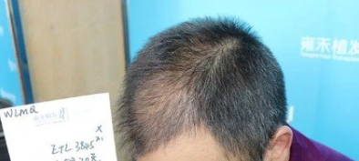 烏魯木齊植發(fā)怎么樣？附案例效果對比就知道了