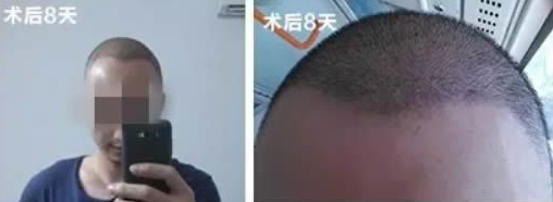 我去哈爾濱植完發(fā)后九個月，究竟發(fā)生了什么讓我如此高興