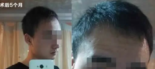 我去哈爾濱植完發(fā)后九個月，究竟發(fā)生了什么讓我如此高興