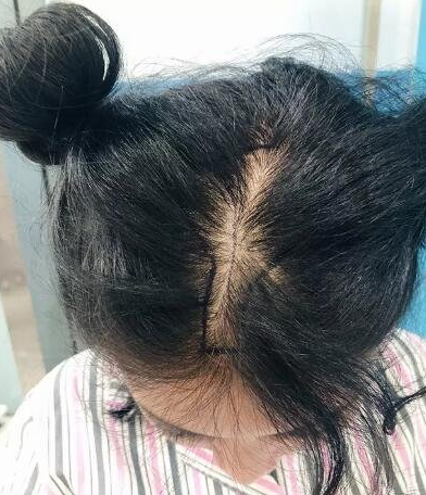 哈爾濱植發(fā)案例對(duì)比圖，植完發(fā)后整個(gè)人看著年輕了