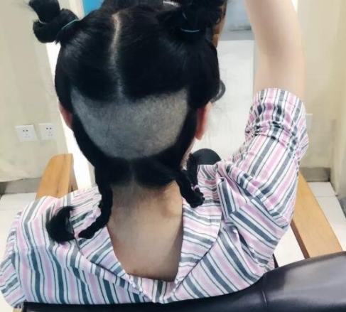 哈爾濱植發(fā)案例對(duì)比圖，植完發(fā)后整個(gè)人看著年輕了