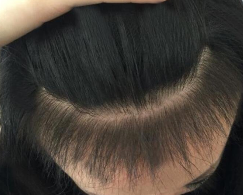 哈爾濱植發(fā)案例對(duì)比圖，植完發(fā)后整個(gè)人看著年輕了