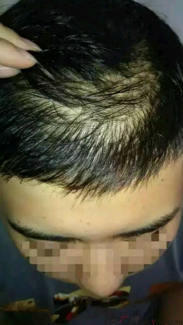 成都植發(fā)加密1500單位，讓頭發(fā)再次濃密自信去相親