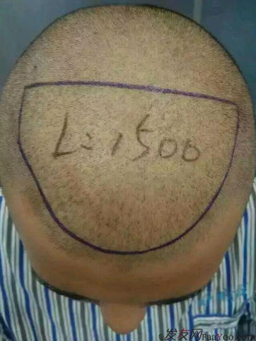 成都植發(fā)加密1500單位，讓頭發(fā)再次濃密自信去相親