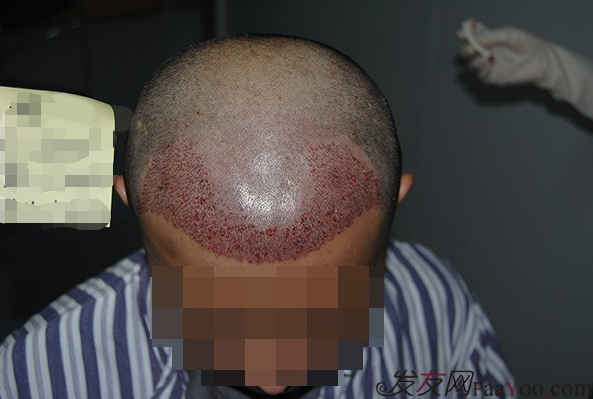 廣州雍禾植發(fā)2200單位成功，拋掉了心中所有的不快樂