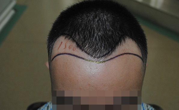 成都雍禾植發(fā)1500單位，額角頭發(fā)滿了，還找到了我心愛(ài)的女朋友