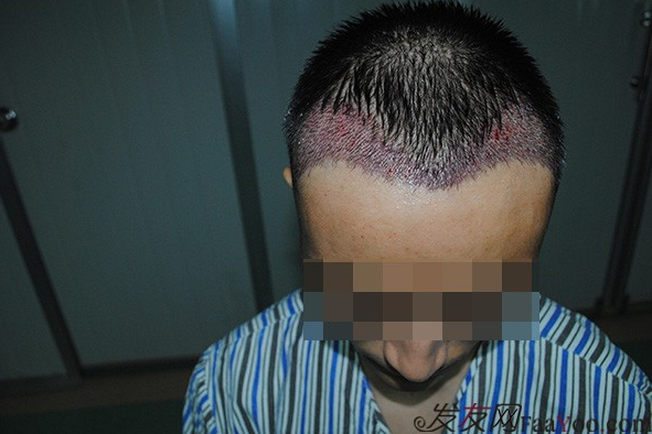 成都雍禾植發(fā)1500單位，額角頭發(fā)滿了，還找到了我心愛(ài)的女朋友